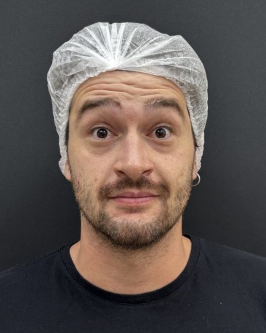 Antes da toxina botulínica