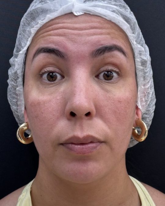 Antes da toxina botulínica